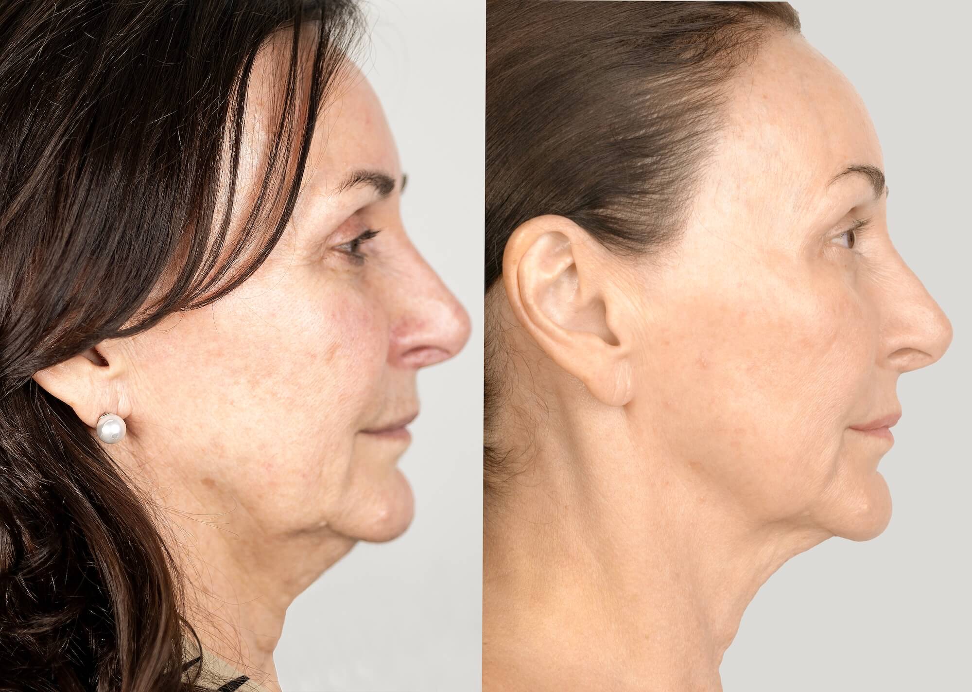 NeoGen Triple Collagen Reset Package
